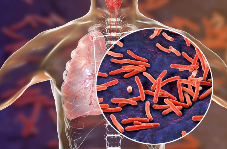 Alerta por tuberculosis en la cárcel de Chillán: cinco casos confirmados y un reo fallecido